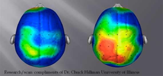 Til venstre et billede af en hjerne hos en person, der har siddet stille og til højre en hjerne hos en person, som har bevæget sig i 20 minutter.