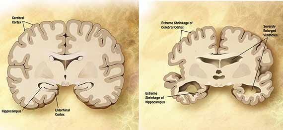 Patienter med Alzheimers mister store dele af hjernen (til højre), men ser ud til at opbygge små fedtdepoter, som forskerne tror accelerer sygdommen eller måske er årsag til den.