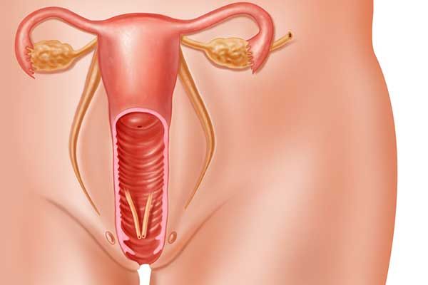Omkring 750 kvinder bliver årligt ramt af kræft i livmoderen, men risikoen kan reduceres markant.